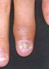 Sormet, joissa nivelpsoriasis sormen nivelissä sekä kynsipsoriasis.