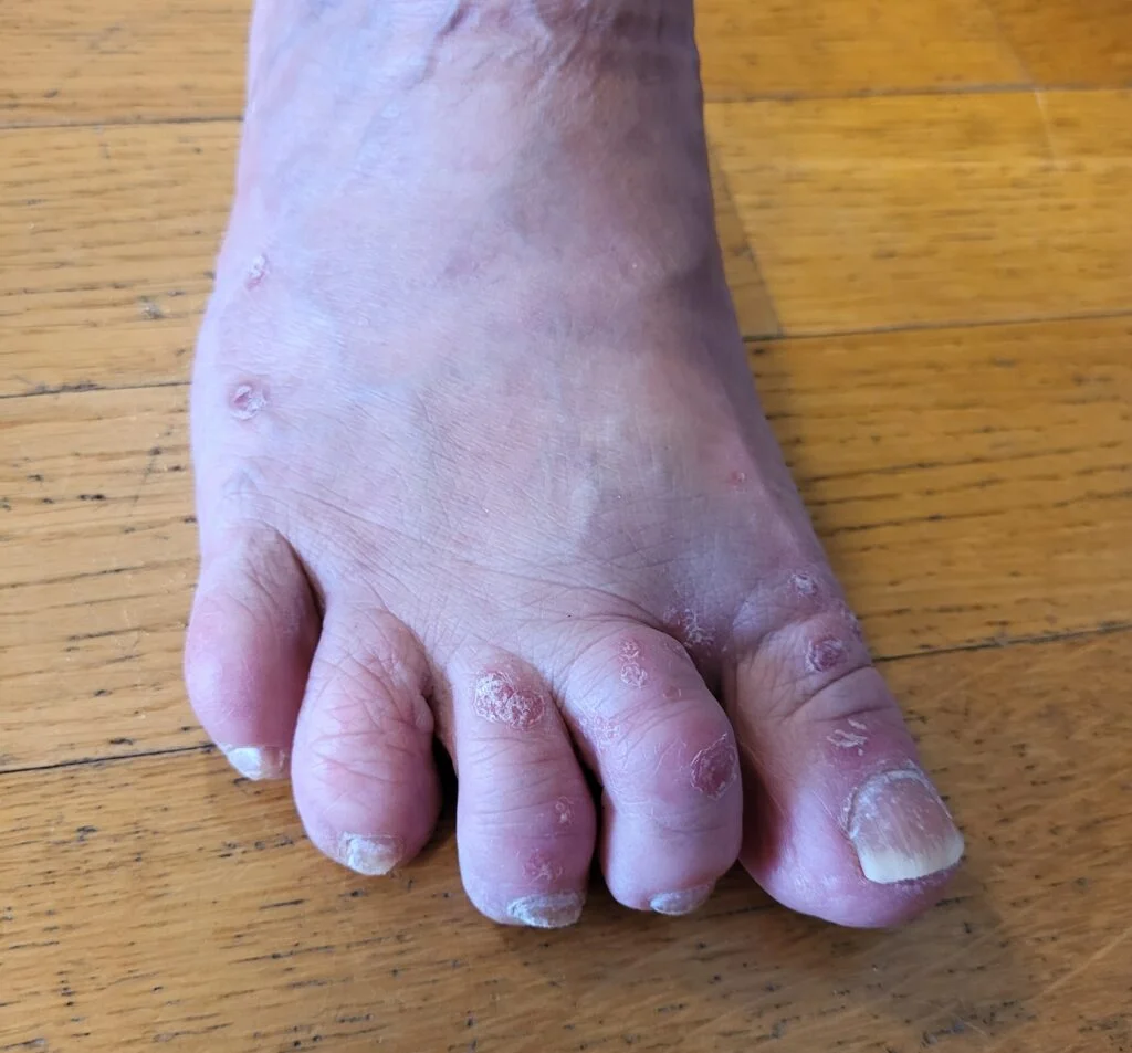 Jalka, jossa on pieniä psoriasisläiskiä ja kuivunut isovarpaan kynsi.