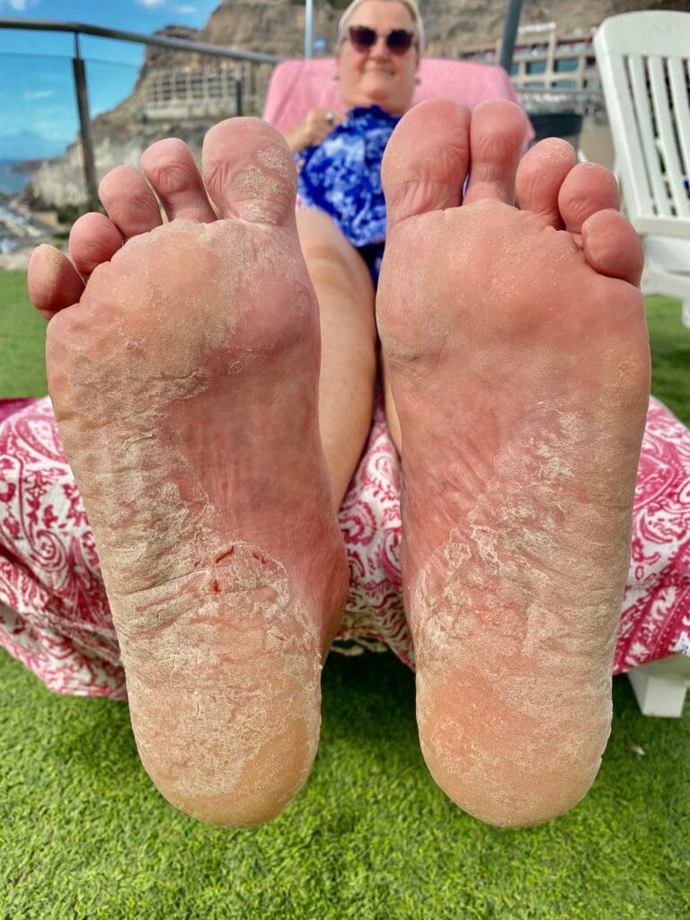 Kristiina Lindholmin jalkapohjat, joissa on psoriasisihottumaa.