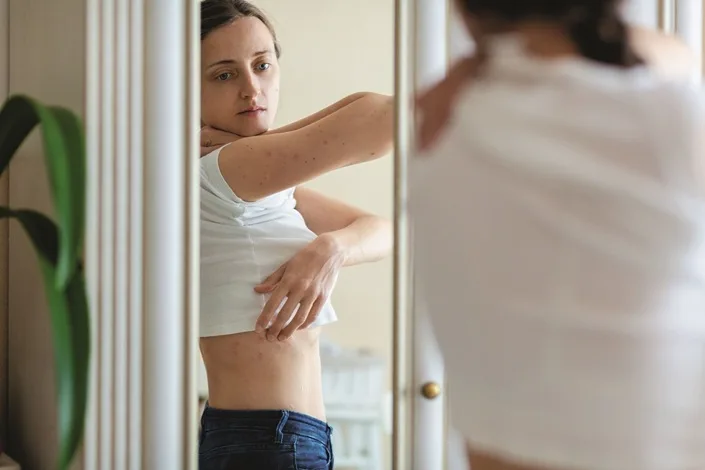 Nainen nostaa paidan helmaa ja katsoo peilistä kyljessään olevaa ihottumaa.